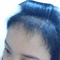 在雍禾植發(fā)醫(yī)院做微創(chuàng)微創(chuàng)植發(fā)經(jīng)歷分享，植發(fā)果很好