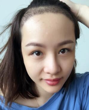 植發(fā),種發(fā)際線真實(shí)案例分享