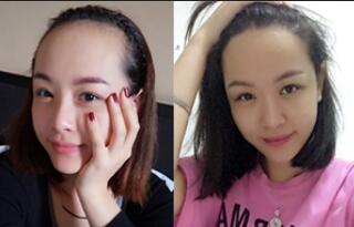 植發(fā)前后對(duì)比圖,種發(fā)際線