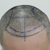 北京微創(chuàng)植發(fā)價格23800元，植發(fā)過程多圖對比分享