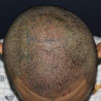 北京微創(chuàng)植發(fā)價格23800元，植發(fā)過程多圖對比分享