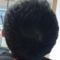 北京微創(chuàng)植發(fā)價格23800元，植發(fā)過程多圖對比分享