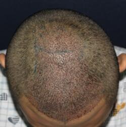 植發(fā)手術是7個醫(yī)生同臺手術的