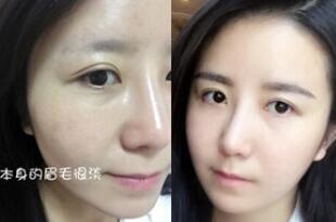 眉毛種植對(duì)比圖