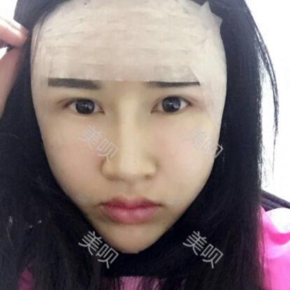 我做的面部年輕化自體脂肪面部填充大家看看怎么樣