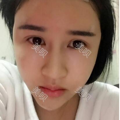 我做的面部年輕化自體脂肪面部填充大家看看怎么樣