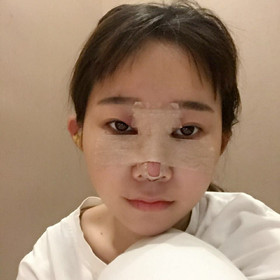 去年11月做的膨體隆鼻手術(shù)，終于擺脫我的塌鼻梁了