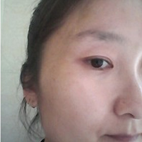 真人記錄了彩光嫩膚前后過程，果真的還不錯