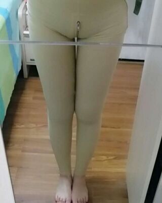 大腿抽脂的親身經(jīng)歷，恢復(fù)情況還不錯(cuò)