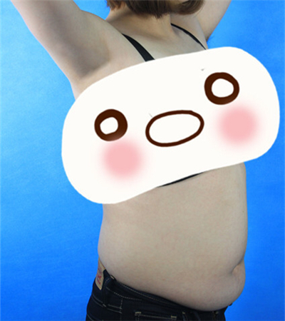 分享我的吸脂瘦腰腹手術(shù)經(jīng)歷，還有前后的照片哦~