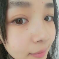 臉上激光去痣日志分享，一共去痣2次