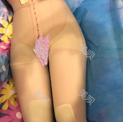 大腿抽脂瘦大腿恢復全過程我也有纖細的美腿了