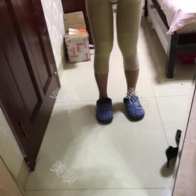 大腿抽脂瘦大腿恢復全過程我也有纖細的美腿了