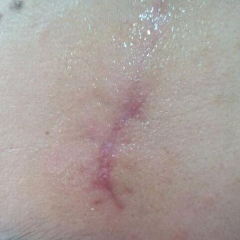 分享下我的手術切除祛疤過程路給大家做個參考