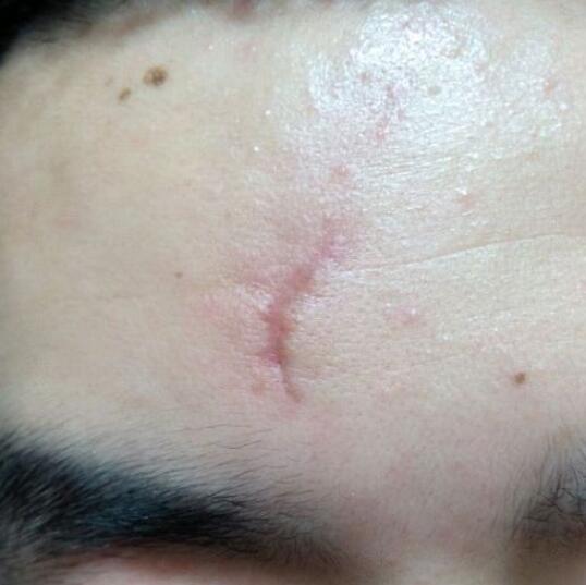 分享下我的手術切除祛疤過程路給大家做個參考