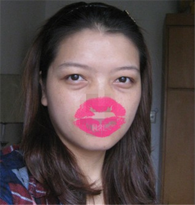 外切去眼袋手術(shù)過(guò)程和恢復(fù)前后對(duì)比照片分享，劉志飛醫(yī)生做的~