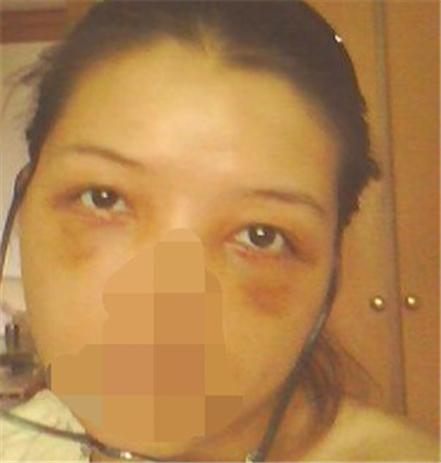 外切去眼袋手術(shù)過(guò)程和恢復(fù)前后對(duì)比照片分享，劉志飛醫(yī)生做的~