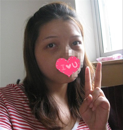 外切去眼袋手術(shù)過(guò)程和恢復(fù)前后對(duì)比照片分享，劉志飛醫(yī)生做的~