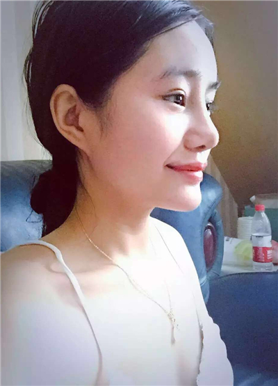 我做自體脂肪隆鼻手術(shù)恢復(fù)過程和前后對(duì)比果圖片分享哦~