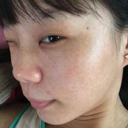 激光祛斑——雀斑后臉上終于白凈了