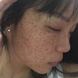激光祛斑——雀斑后臉上終于白凈了