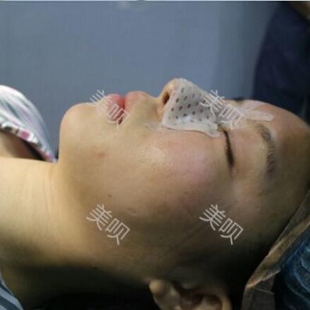 硅膠假體隆鼻+耳軟骨墊鼻尖大家看看果還不錯吧