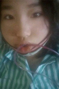 下頜角切除手術(shù)之后，我也變成小V臉了!