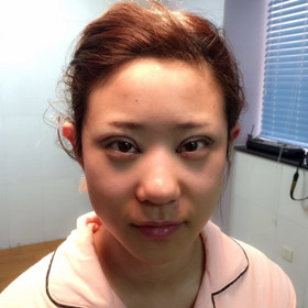 切開雙眼皮+開內(nèi)眼角手術(shù)前后過程，還有對比照片喲!