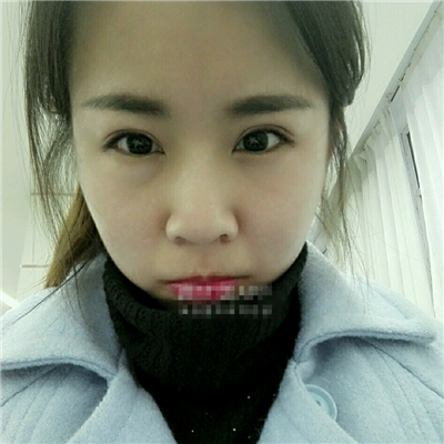 注射瘦臉去魚尾紋恢復過程和前后對比果圖片分享，上海東方做的~