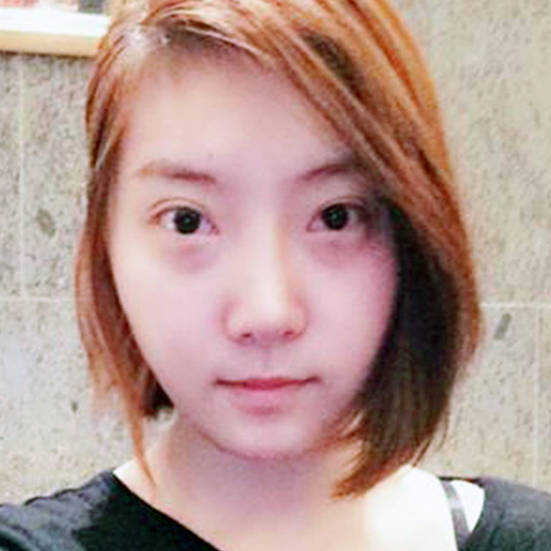 米蘭柏羽做了外切去眼袋，分享手術(shù)前后對比果圖片哦~