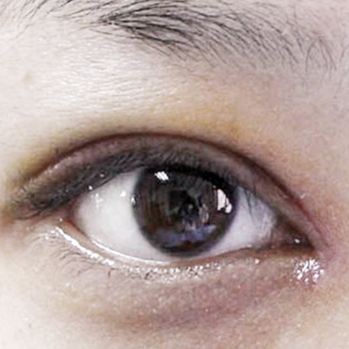 米蘭柏羽做了外切去眼袋，分享手術(shù)前后對比果圖片哦~