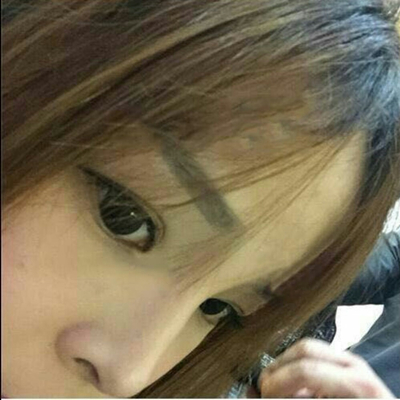 玻尿酸注射隆鼻三個月了，分享術后恢復照片哇~