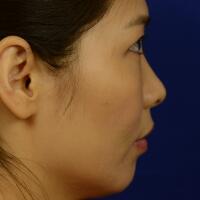 去醫(yī)院做了面部埋埋蛋白線.提升，肌膚緊致果不錯