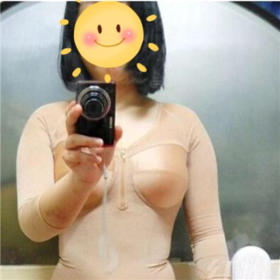 腰腹部吸脂減肥手術(shù)恢復(fù)過程和前后對比果圖片分享~