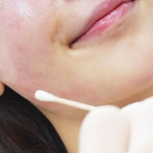 注射水光補(bǔ)水嫩膚果照片分享，杭州藝星柏亞萍醫(yī)生做的哦~