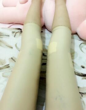 吸脂減肥瘦大腿第8天了,今天去拆線