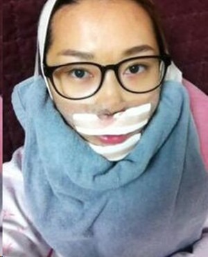 地包天手術(shù)前后過程以及對比照，真實(shí)案例分享