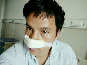 記錄了隆鼻整形（膨體隆鼻+鼻翼縮?。┦中g(shù)前后的過程，還有對比照片哦