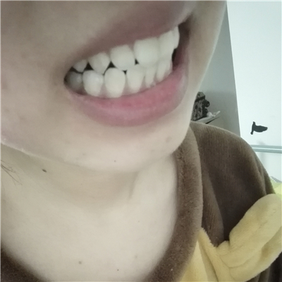 這個(gè)月在華西做了洗牙齒，果很好，分享恢復(fù)過程照片~