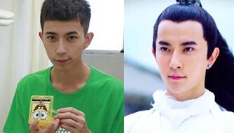 于朦朧墊下巴手術(shù)前后對(duì)比圖