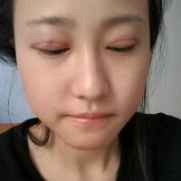 割雙眼皮恢復(fù)過程分享，整形價格3800元