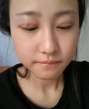 割雙眼皮整形恢復(fù)過程分享