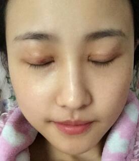 割雙眼皮術(shù)后七天