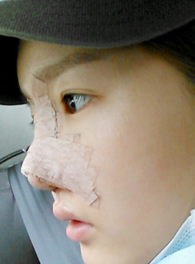 隆鼻術(shù)失敗修復(fù)整形術(shù)后果分享