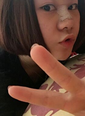 隆鼻整形前后對比照片 果是不是很好呀