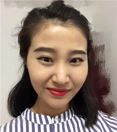 玻尿酸注射隆鼻前后對比果圖片分享，大同美神賈文醫(yī)生做的~