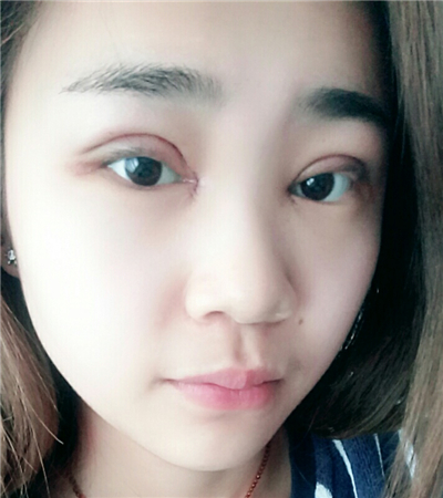 開內(nèi)眼角+切開雙眼皮前后對比果圖片分享，青島金島韓勝醫(yī)生做的~