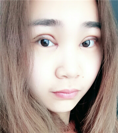 開內(nèi)眼角+切開雙眼皮前后對比果圖片分享，青島金島韓勝醫(yī)生做的~