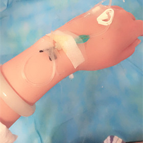 大腿抽脂手術(shù)后，還我小細(xì)腿!還有對(duì)比照片喲!