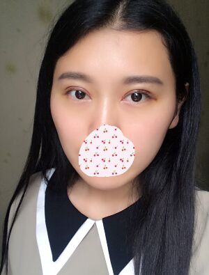 雙眼皮失敗修復(fù)手術(shù)恢復(fù)超自然，看起來一點都不假